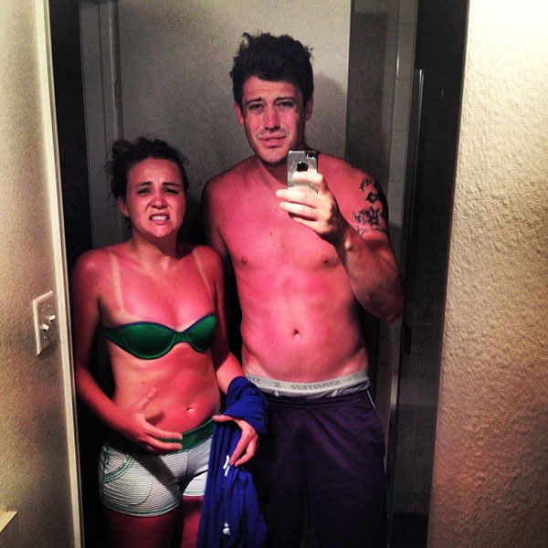 best-viral-pictures-week-12-sunburn