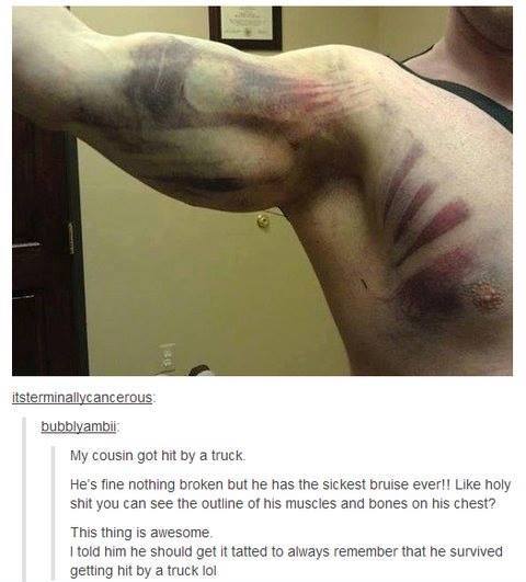 Coolest Bruise