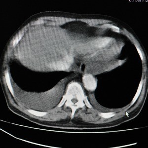 X Ray Liver