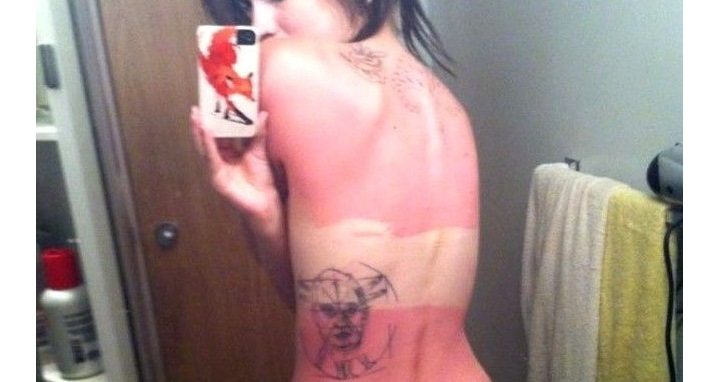 Painful Sunburns